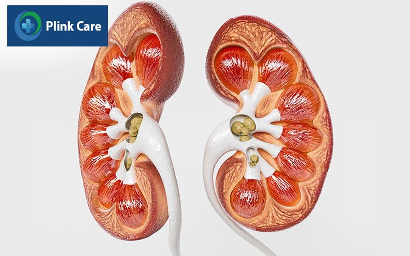 sỏi thận có nguy cơ cao mắc gút