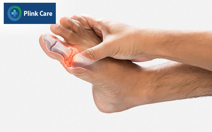 sự xuất hiện của urat