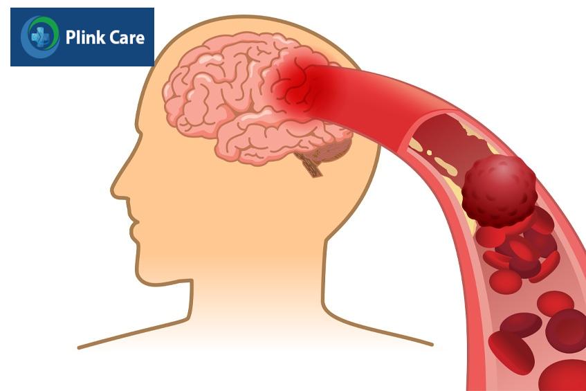 tắc mạch máu não có chữa được không