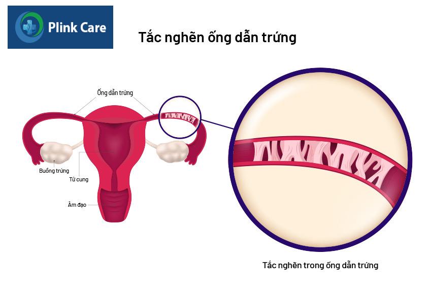 Tắc nghẽn ống dẫn trứng do viêm nhiễm, nhiễm trùng