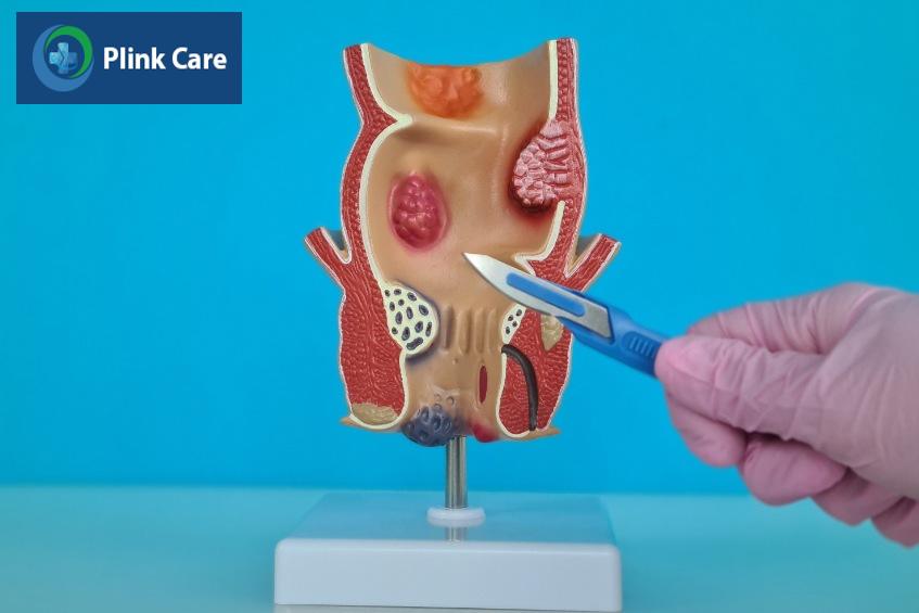 tái phát rò hậu môn sau khi mổ