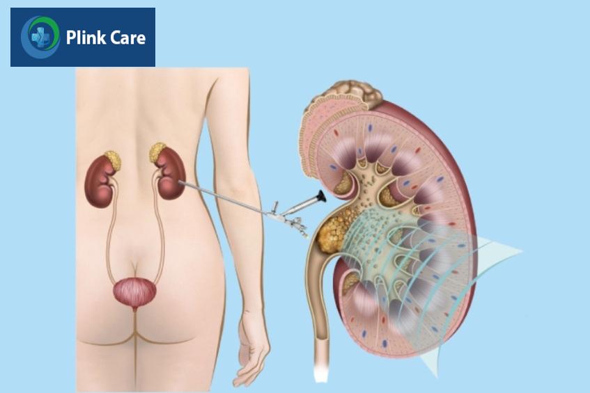 tán sỏi qua da là phương pháp điều trị hiệu quả