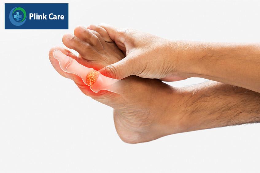 Tăng acid uric máu tiền đề bệnh gout
