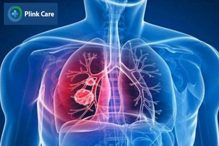 tế bào ung thư di căn từ phổi tới hạch trung thất