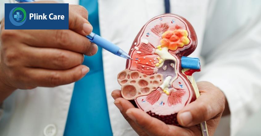thận ứ nước cấp độ 1