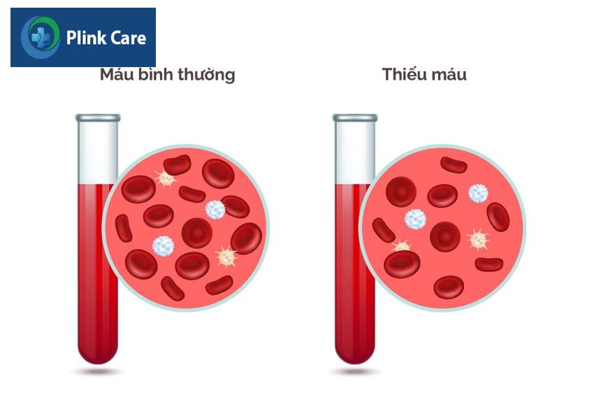 Thiếu máu là do sụt giảm số lượng hồng cầu và nồng độ huyết sắc tố