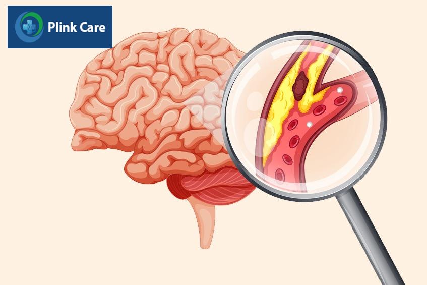 tiên lượng bệnh tắc mạch máu não