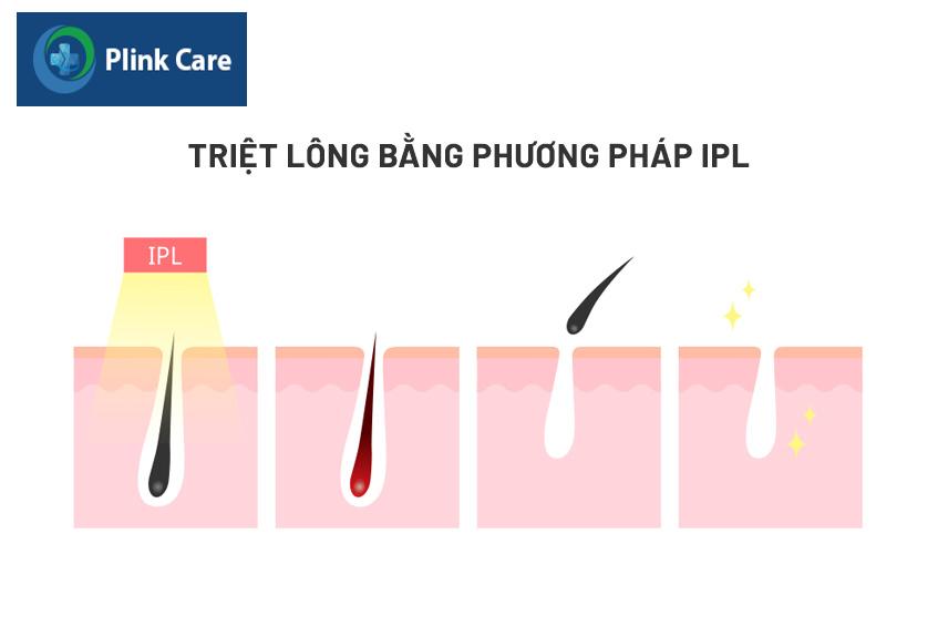 triệt lông bằng phương pháp ipl