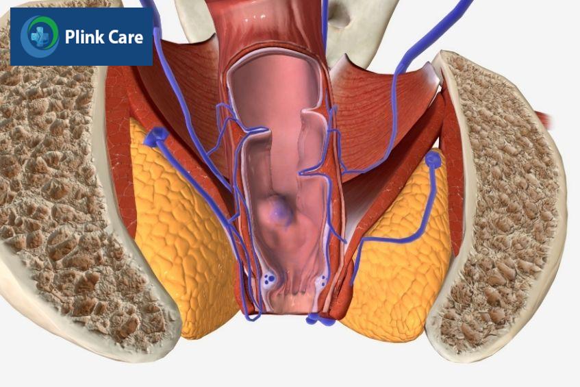 triệu chứng rò hậu môn tái phát