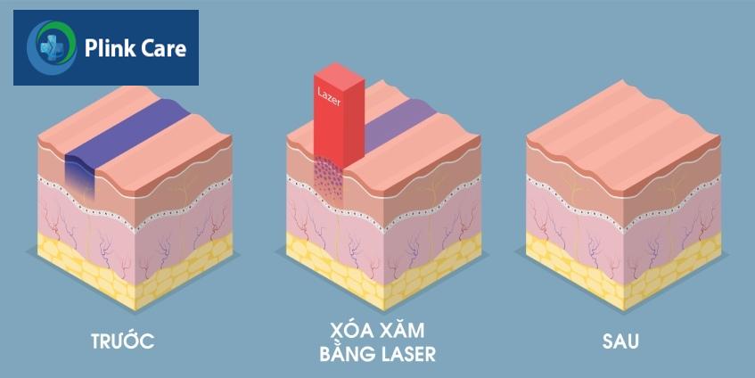 trước và sau khi lựa chọn xóa xăm bằng laser