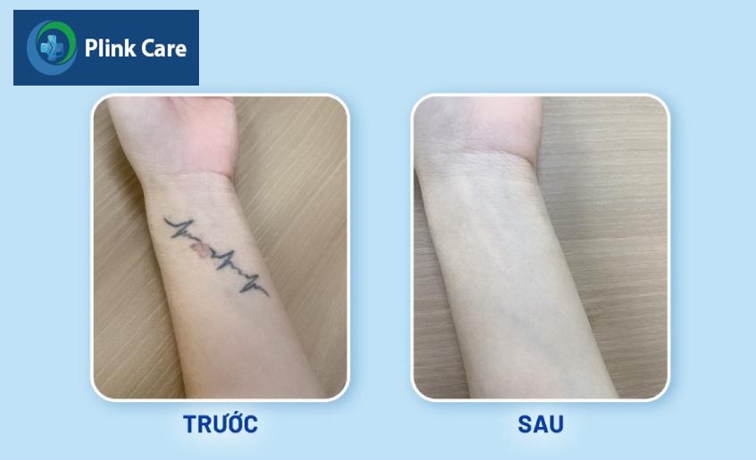 trước và sau khi xóa xăm