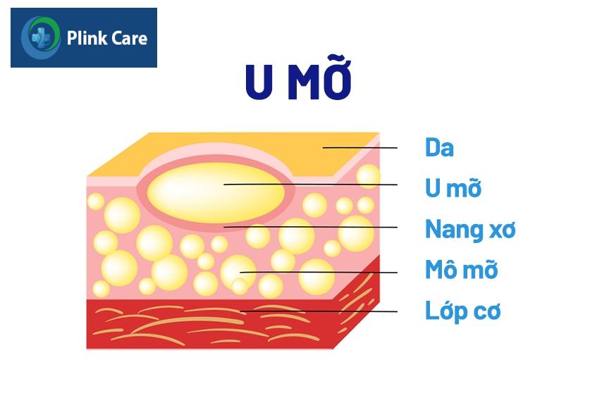 u mỡ ở ngực có nguy hiểm không