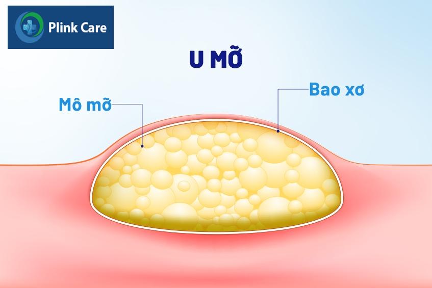 u mỡ ở ngực