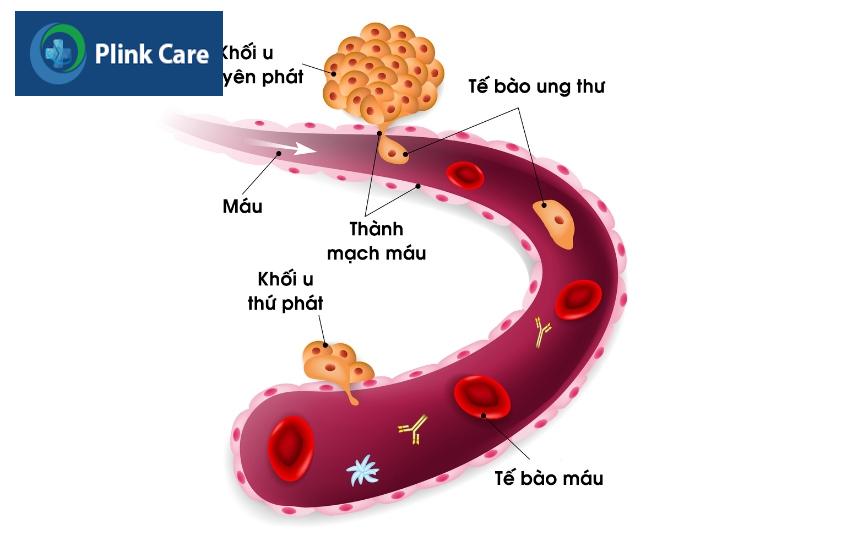 ung thư vú di căn vào phổi