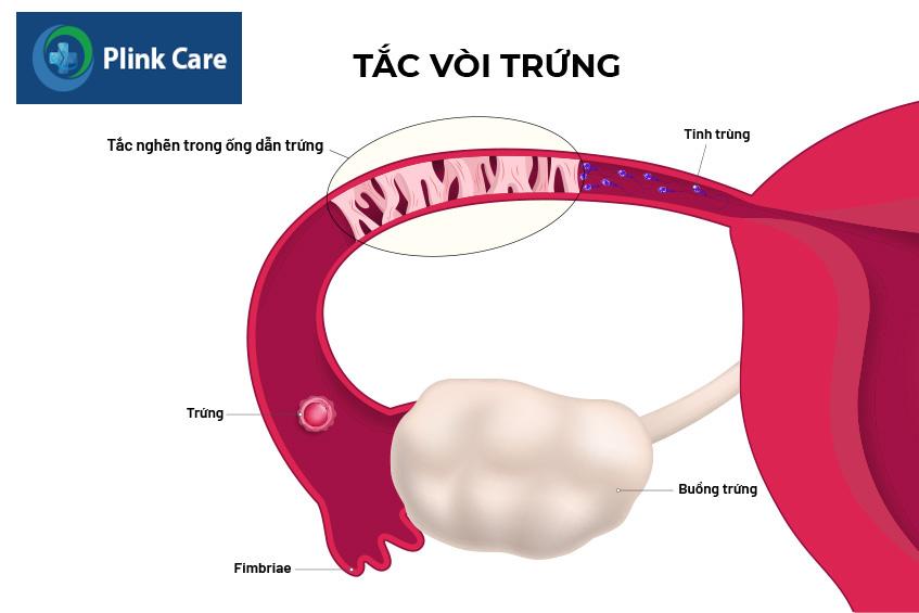 Vòi trứng bị ứ tắc gây cản trở đường đi của tinh trùng