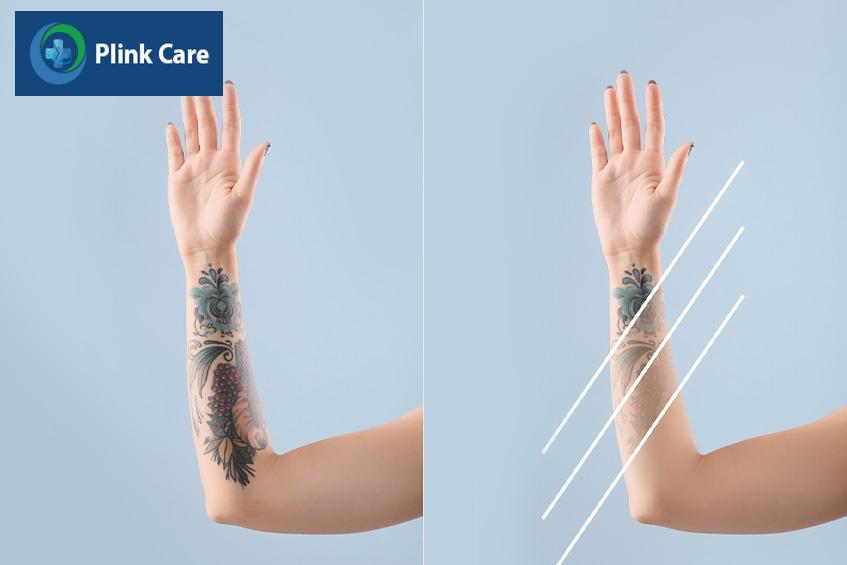xóa xăm laser có hiệu quả không