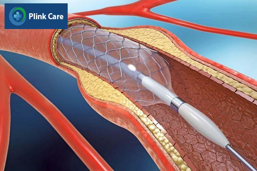 Bệnh nhân nhồi máu cơ tim phải đặt stent để điều trị