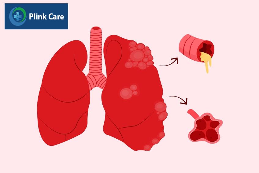 Bệnh phổi tắc nghẽn mạn tính là căn bệnh không lây nhiễm