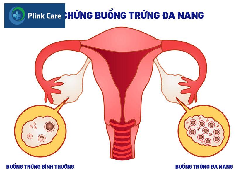 buồng trứng đa nang làm nữ giới mất kinh 3 tháng