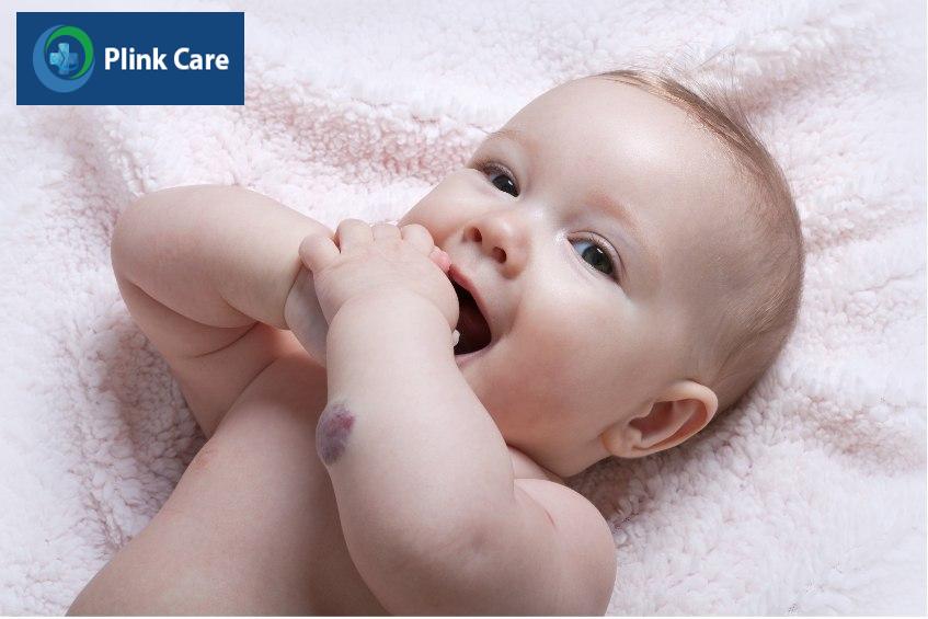 Bướu máu nằm dưới da, đội lớp da lên tạo thành khối u