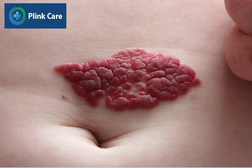 Bướu máu trên bề mặt da thường có màu đỏ với bề mặt gồ ghề