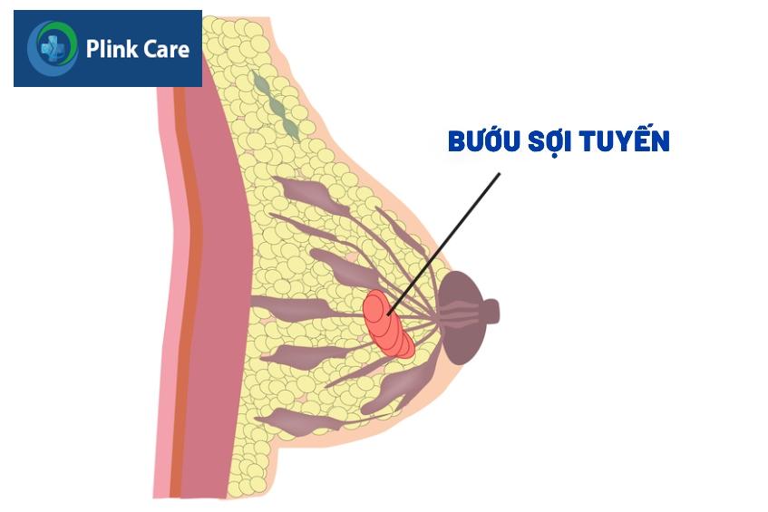 bướu sợi tuyến vú birads 3