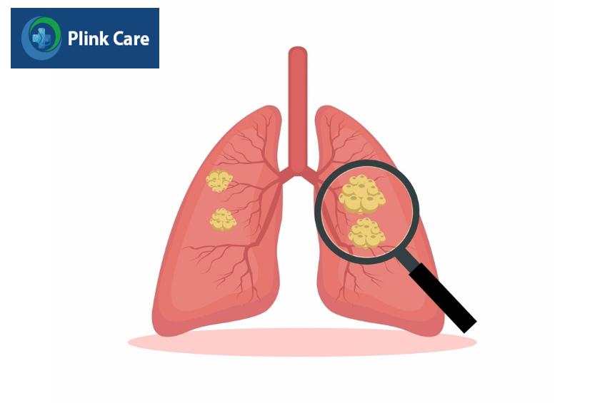 Các biến chứng của ung thư phổi