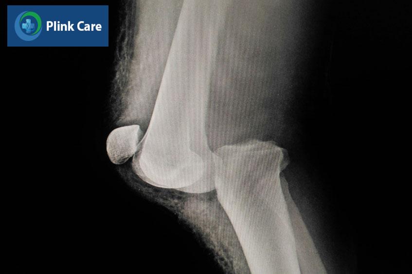 các dấu hiệu khớp gối bị trật
