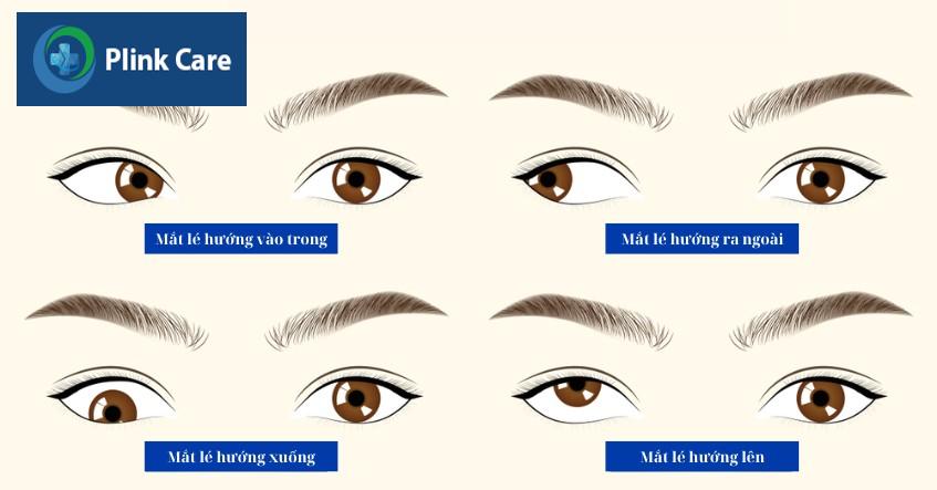các loại mắt lé