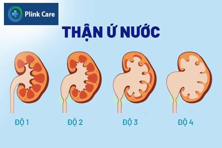 cấp đọ thận ứ nước