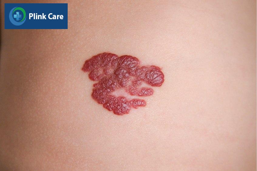 Thăm khám lâm sàng chẩn đoán bệnh bướu máu