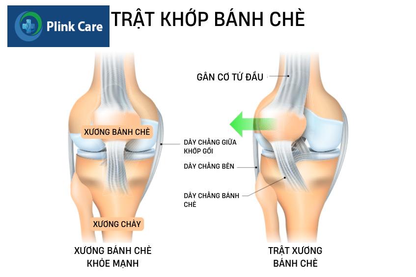 chấn thương trật xương bánh chè