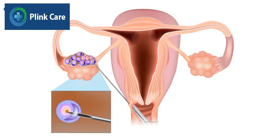 Chọc hút trứng để lấy noãn, chuẩn bị cho quá trình IVF/ICSI