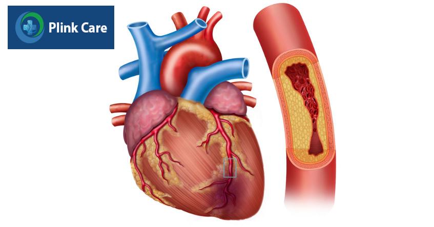 Cholesterol cao nguy cơ gây ra bệnh động mạch vành