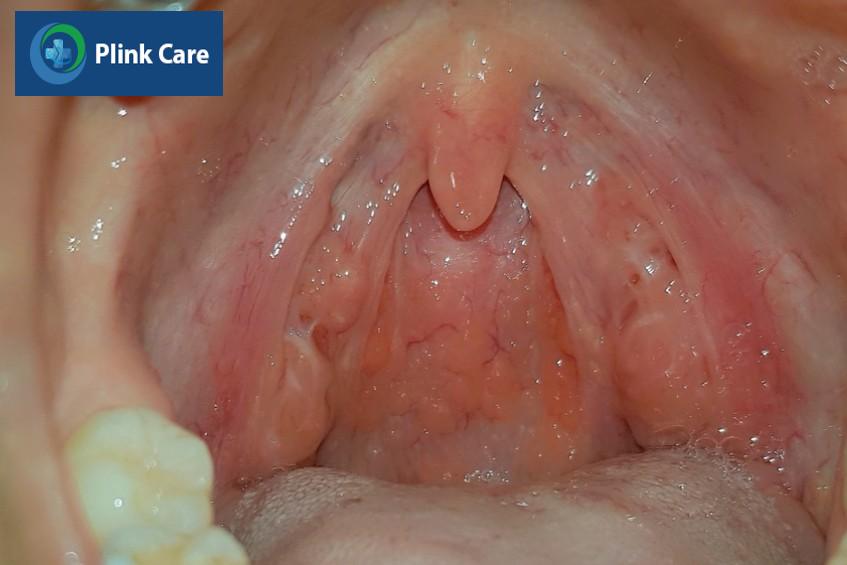 cách chữa trị viêm họng hạt