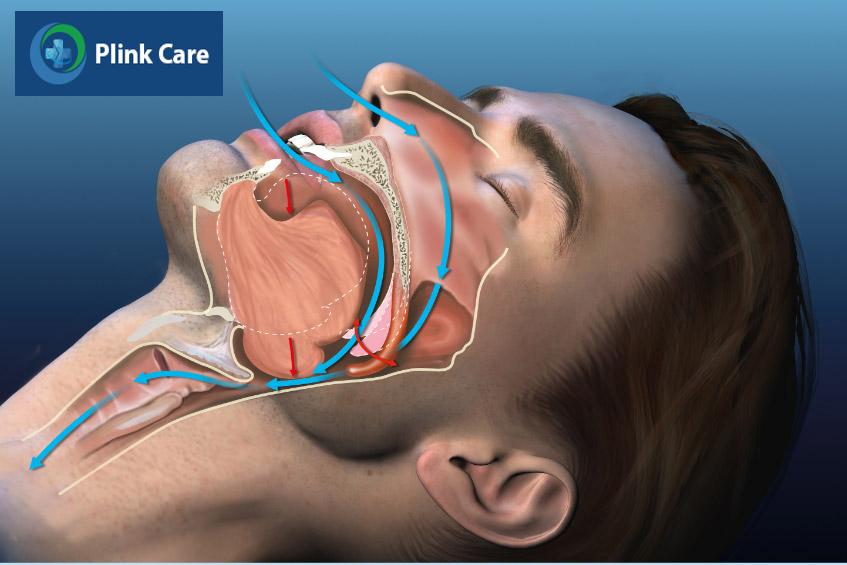 Chứng ngưng thở khi ngủ mạn tính gây tăng huyết áp tâm trương