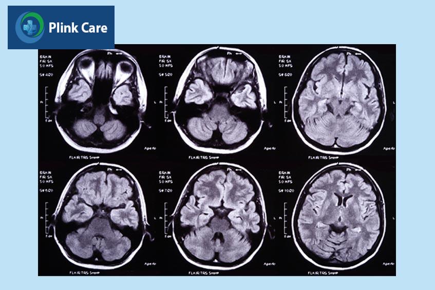 chụp ct máu tụ dưới màng cứng mãn tính
