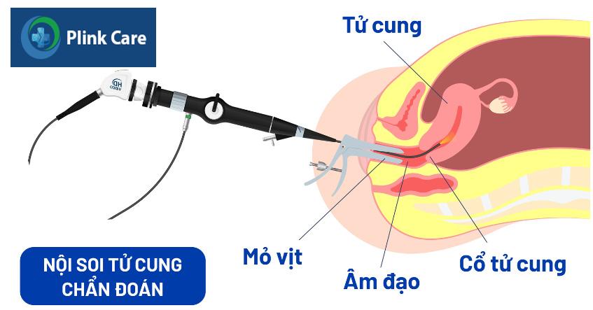 Chụp X-quang tử cung - vòi trứng thường được chỉ định khi đánh giá độ thông của vòi trứng