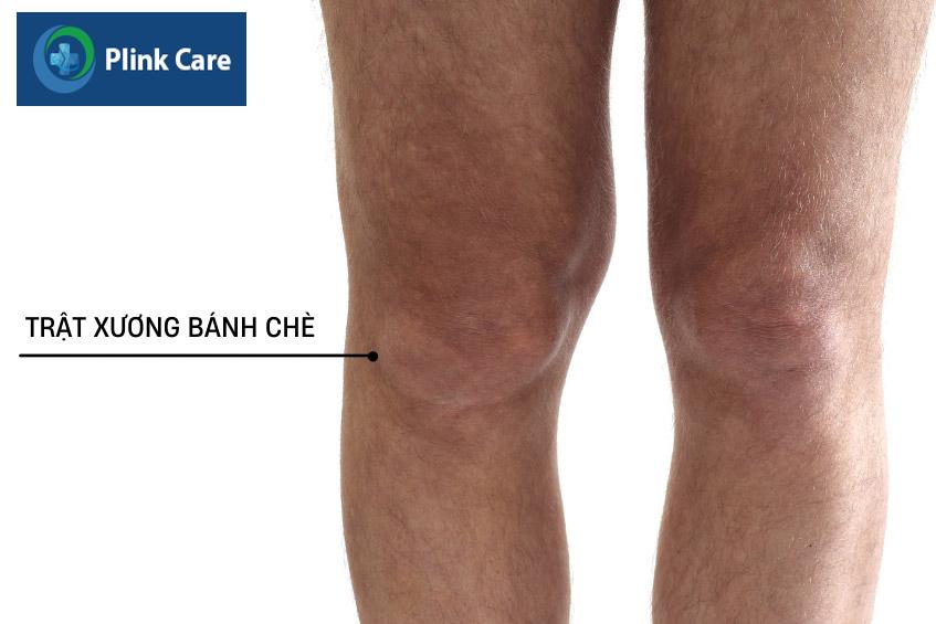 dấu hiệu trật xương bánh chè