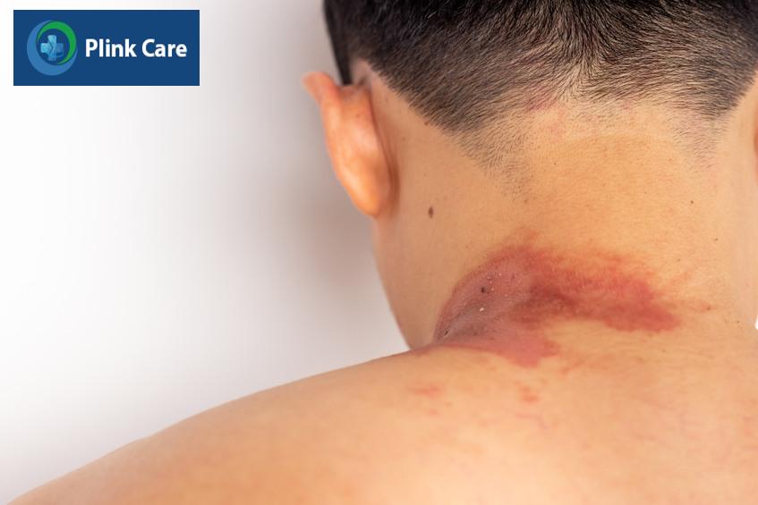 độc tố kiến ba khoang