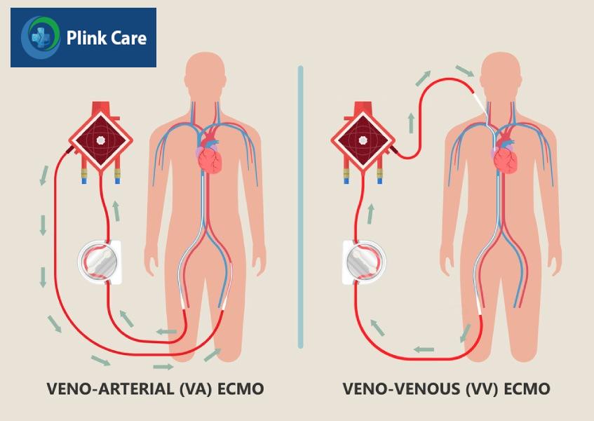 ecmo hoạt động như thế nào
