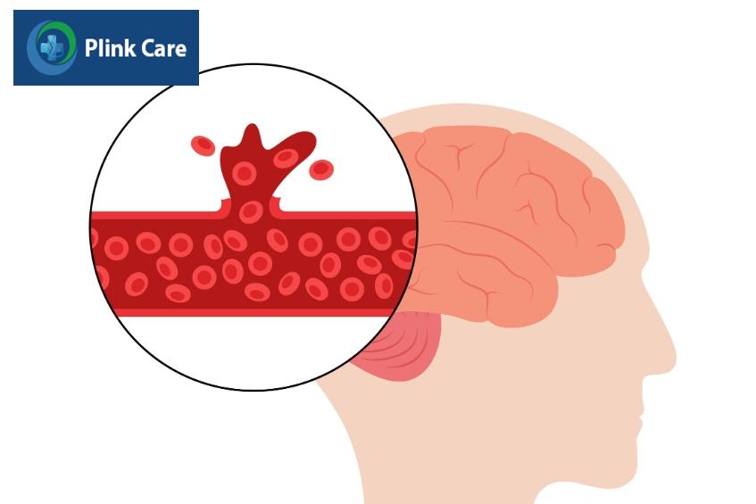 giãn mạch máu não có thể bị vỡ