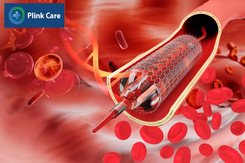 Huyết khối trong stent cấp tính là biến chứng hiếm gặp nhưng vẫn có thể xảy ra