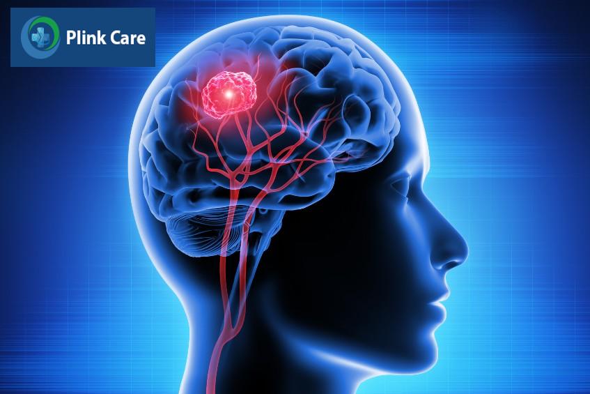 khả năng chữa trị phụ thuộc vị trí khối u não ác tính