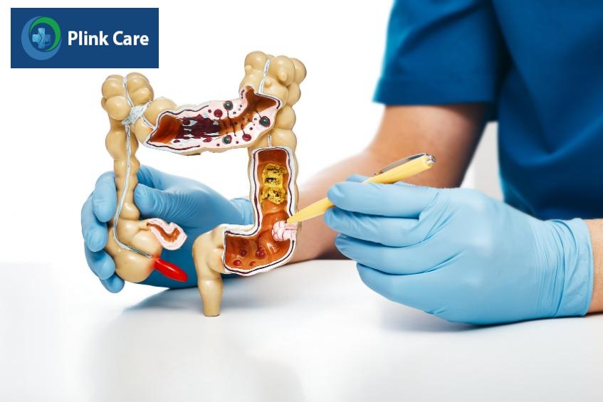 khối u mô đệm đường tiêu hóa