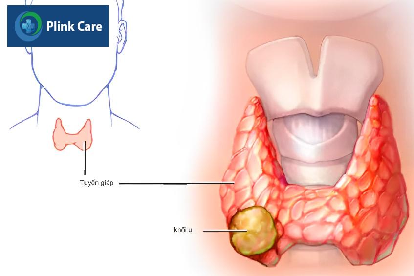 khối u ung thư tuyến giáp giai đoạn cuối ở vùng cổ