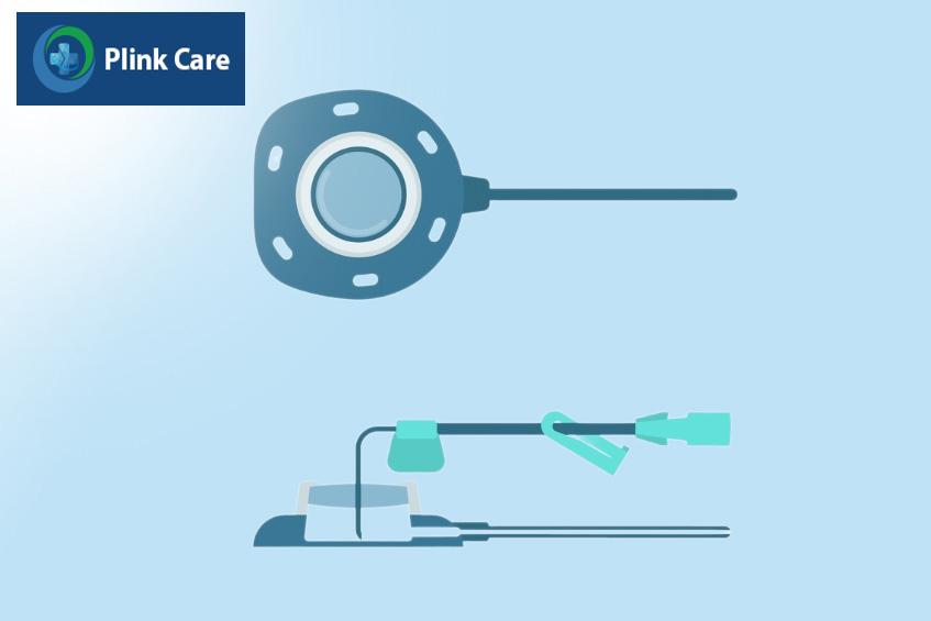 Kim truyền hóa chất được cắm vào buồng tiêm để truyền vào tĩnh mạch qua catheter