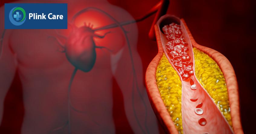 LDL cholesterol cao tích tụ thành mảng bám, gây xơ vữa động mạch