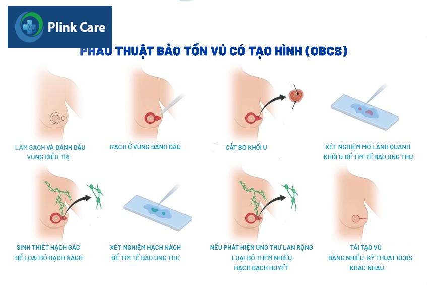 mổ bảo tồn vú có tạo hình