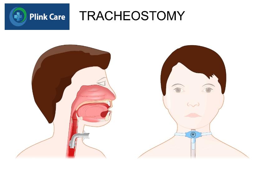 Mở khí quản là một trong những phương pháp phù hợp